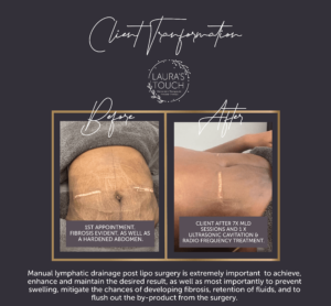 Manual Lymphatic Drainage Client with Fibrosis