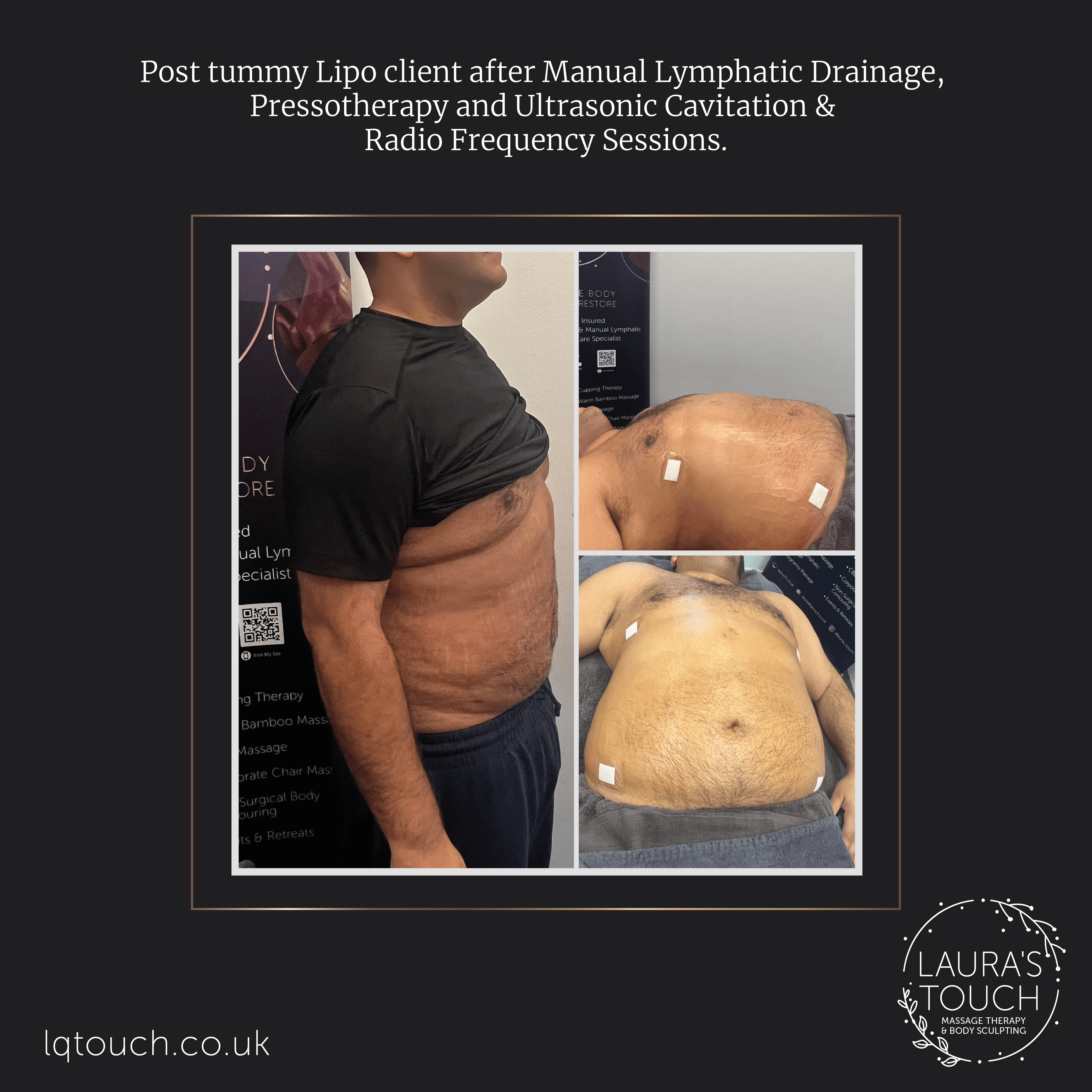 Post Lipo Client Before and After Manual Lymphatic Drainage, Ultrasonic Cavitation, Radio Frequency, Pressotherapy Treatments