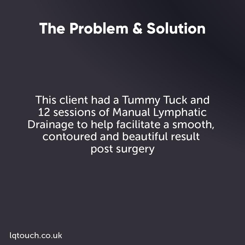 Case study Manual Lymphatic Drainage Tummy Tuck