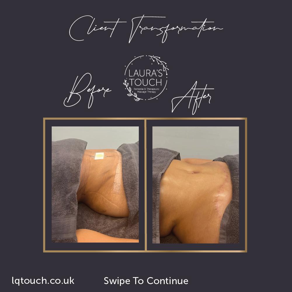 Manual Lymphatic Drainage Post Lipo client