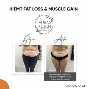 Before and After of a HIEMT Fat Loss and Muscle Gain client at Laura's Touch Bromley Clinic