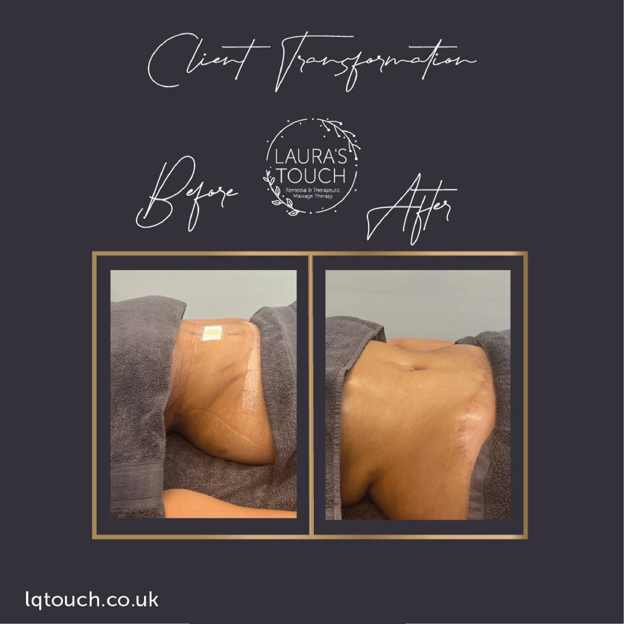 Before and After of Post-Tummy tummy tuck client