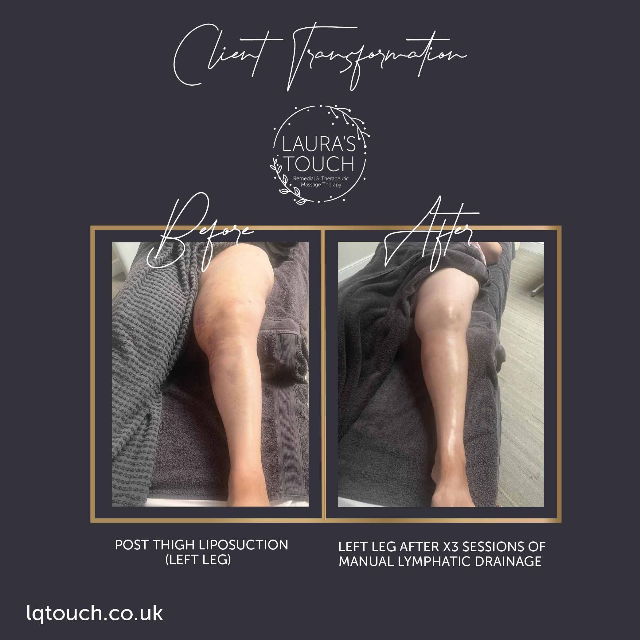 Post Liposuction Left Leg