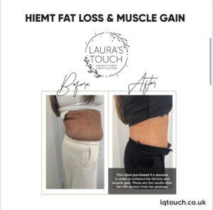 Before and After of a HIEMT Fat Loss and Muscle Gain client, focused on her stomach at Laura's Touch Bromley Clinic.