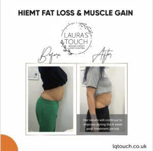 Before and After of a HIEMT Fat Loss and Muscle Gain client, focused on the Abdomen at Laura's Touch Bromley Clinic.