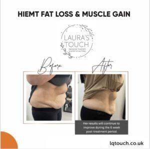 Before and After (Side View) of a HIEMT Fat Loss and Muscle Gain client at Laura's Touch Clinic