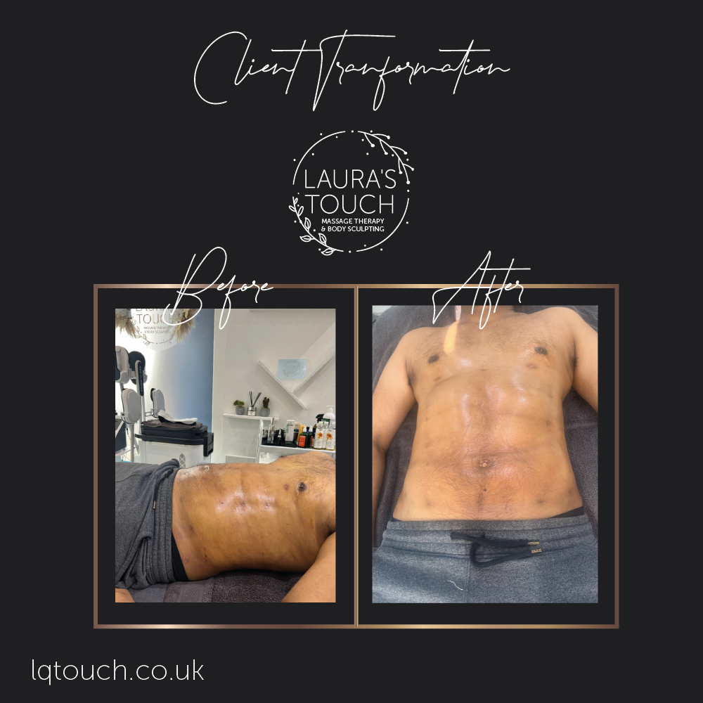 Before and After of Post 360 lipo client who suffered from post lipo fibrosis