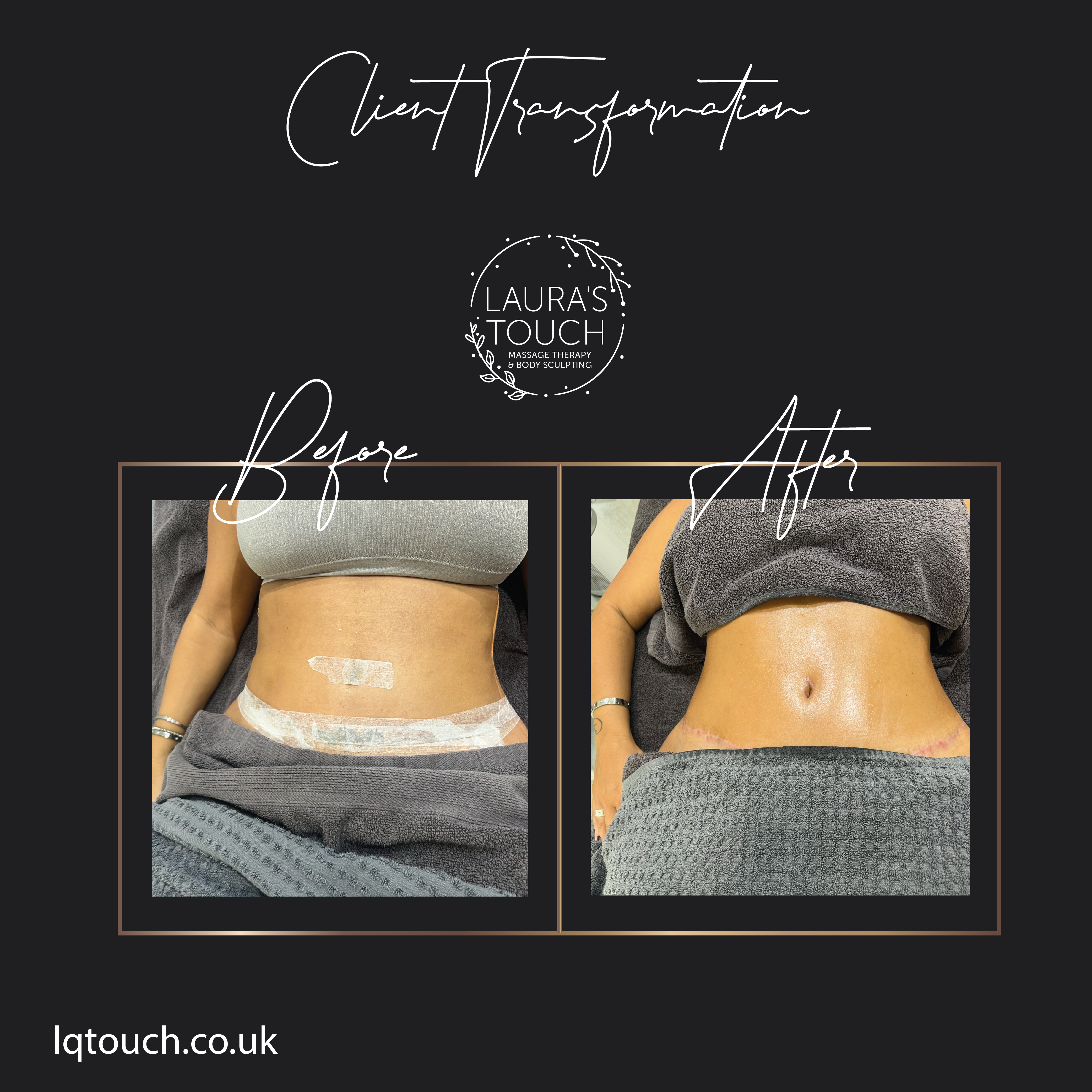 Before and After of a Post 360 Lipo Tummy and Breast Lift