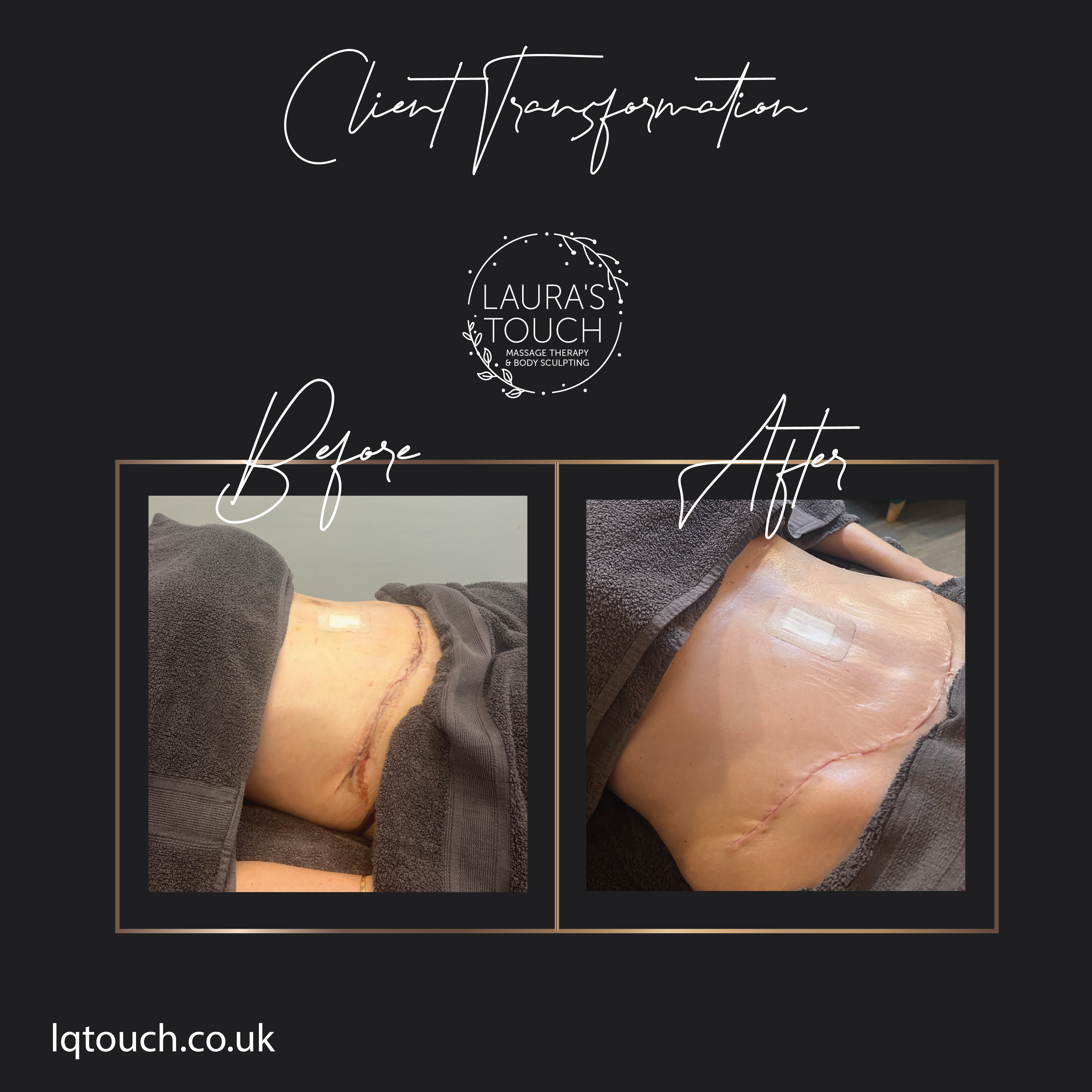 Before and After of a Post 360 Lipo Tummy Tuck Client