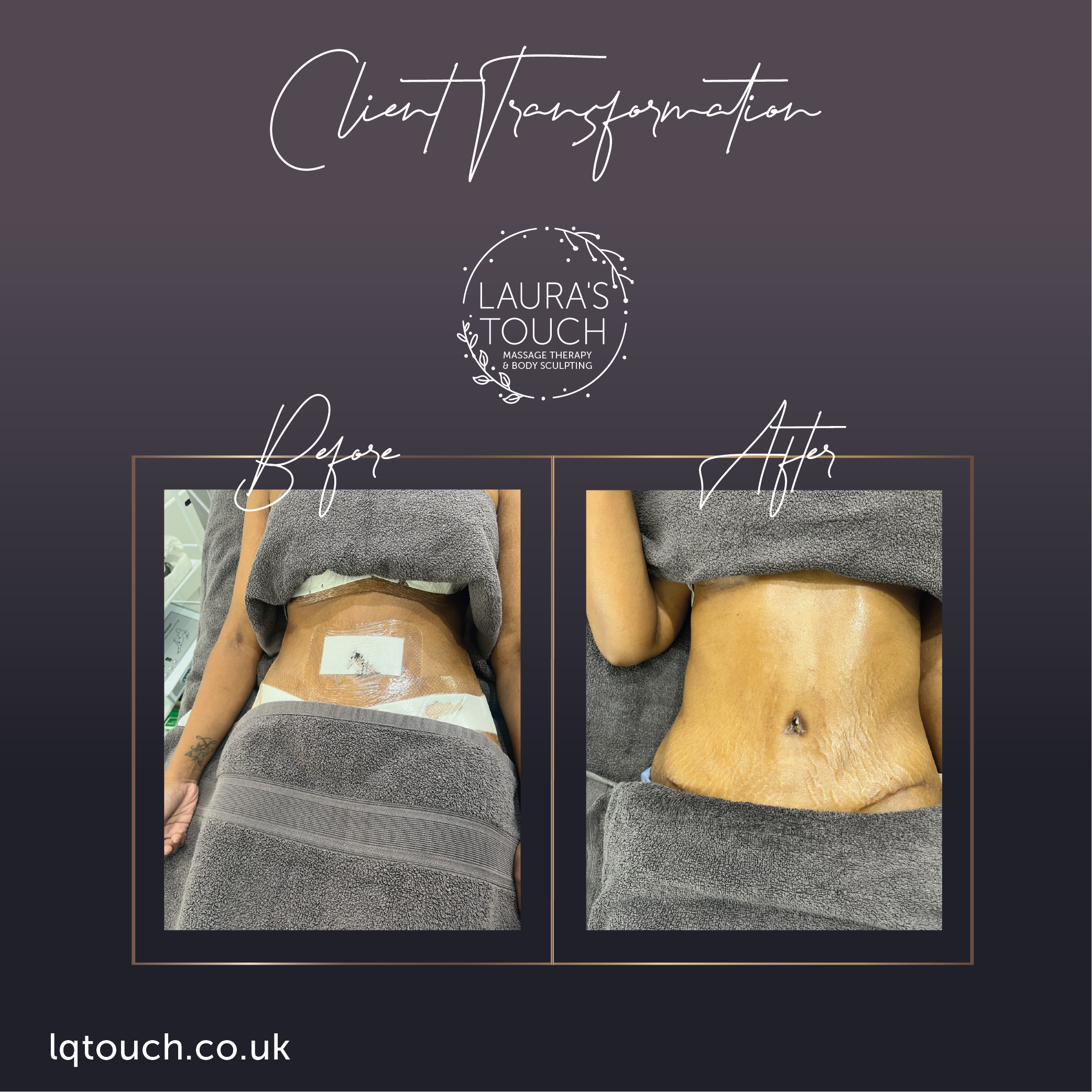 Before and After of a Post 360 Lipo Tummy Tuck Client