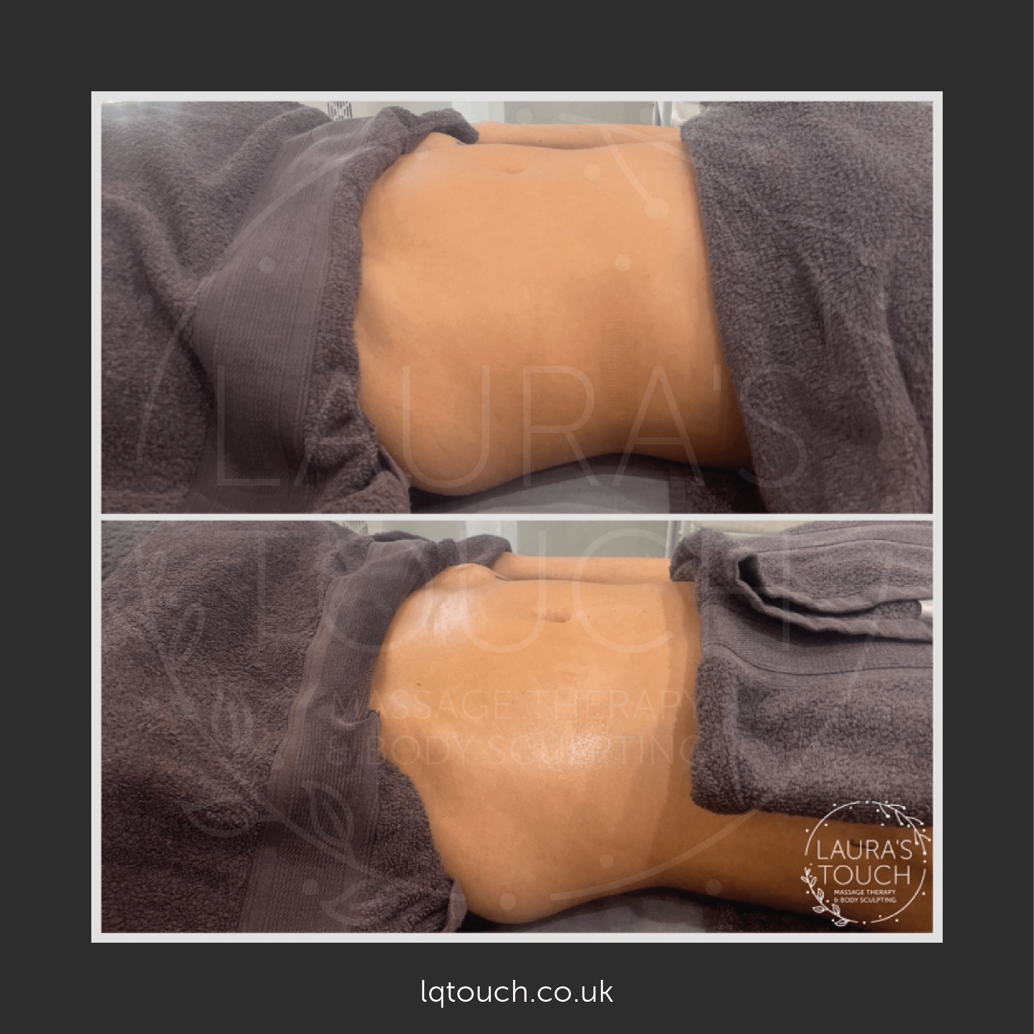 Before and After of a Post Op Manual Lymphatic Drainage client