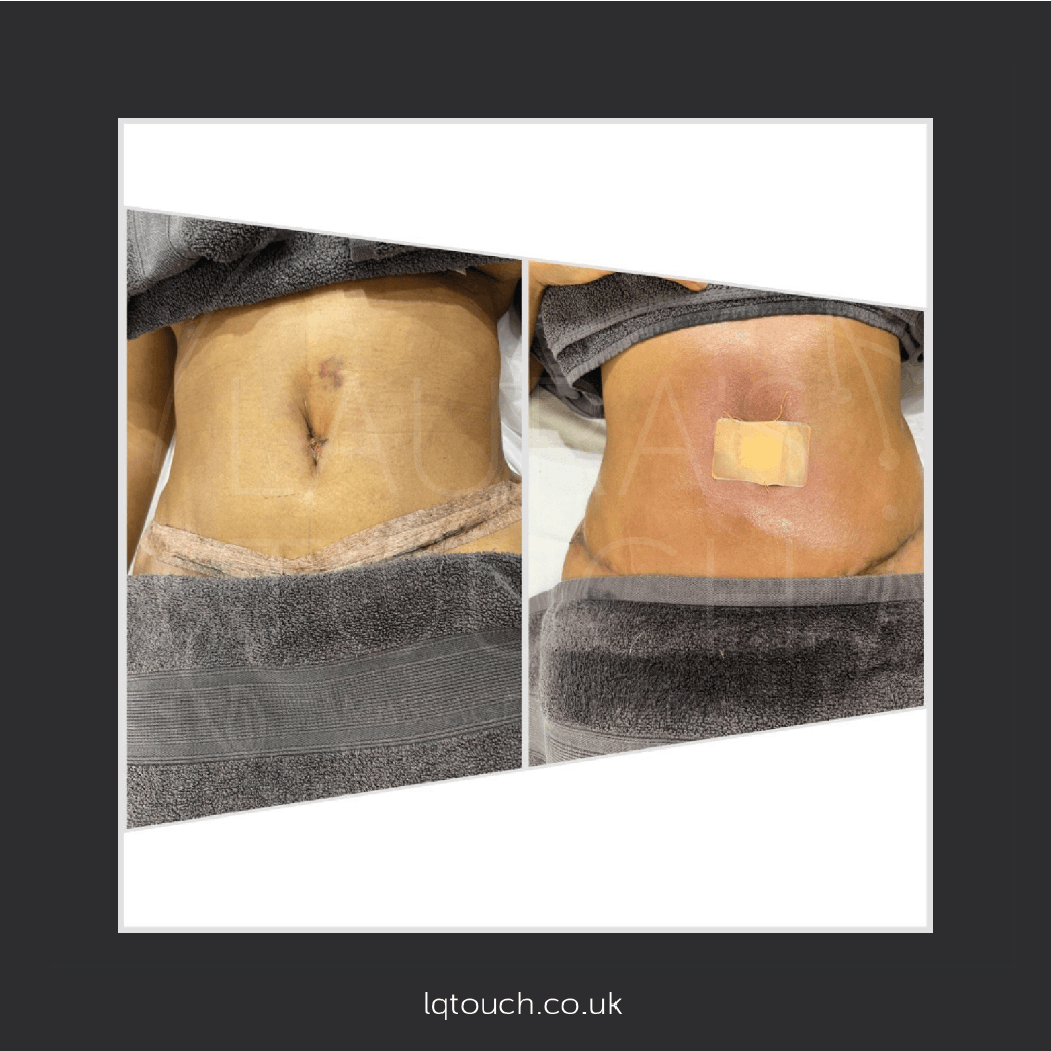 Before and After of a Post 360 Lipo Tummy Tuck Client