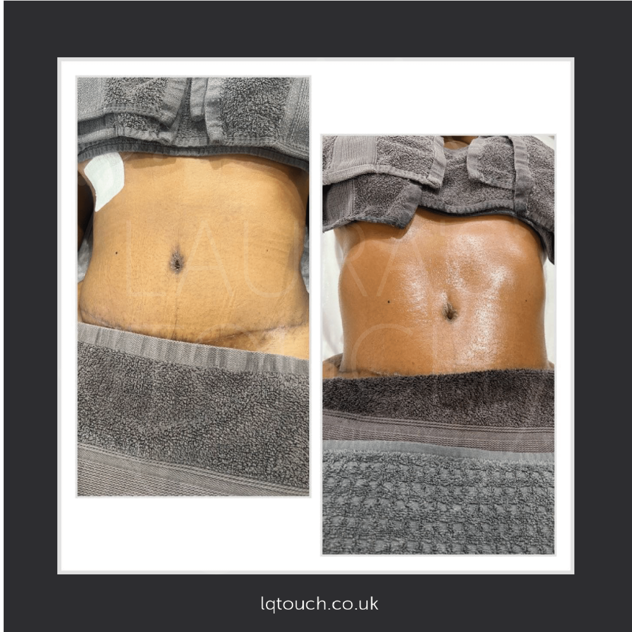 Before and After Client Transformation, Before and After of a 360 Tummy Tuck Client