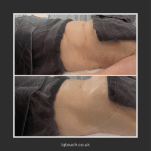 Before and After of a client after a Manual Lymphatic Drainage massage to treat Digestion and Bloating issues