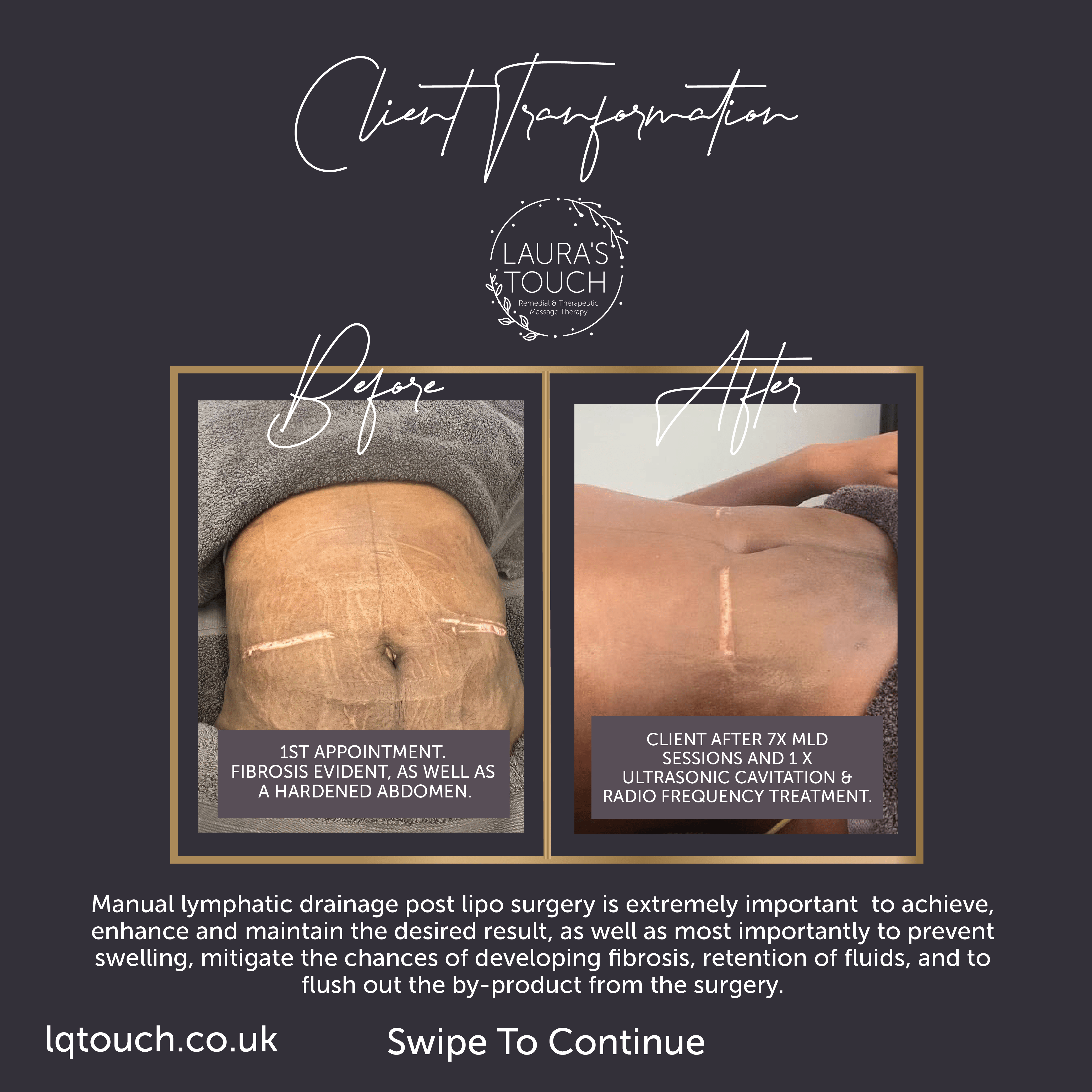 This client had 360 liposuction, however developed an extreme case of post-surgery fibrosis and came to Laura's Touch for treatment