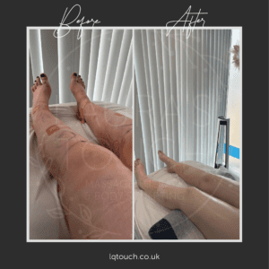 Before and After of a Leg Lipo Post-Op MLD Massage Client