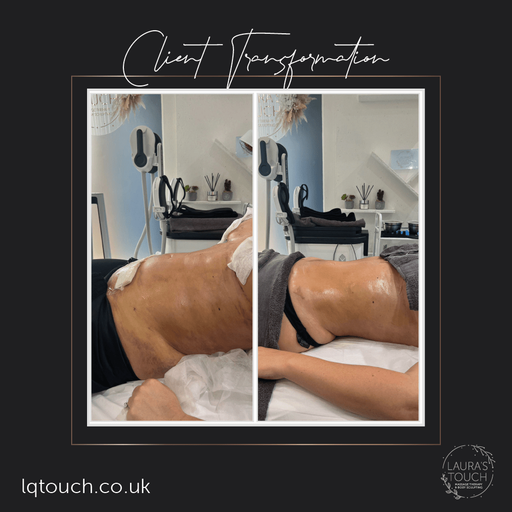 Before and After of a Post 360 Lipo and Breast Lift Client