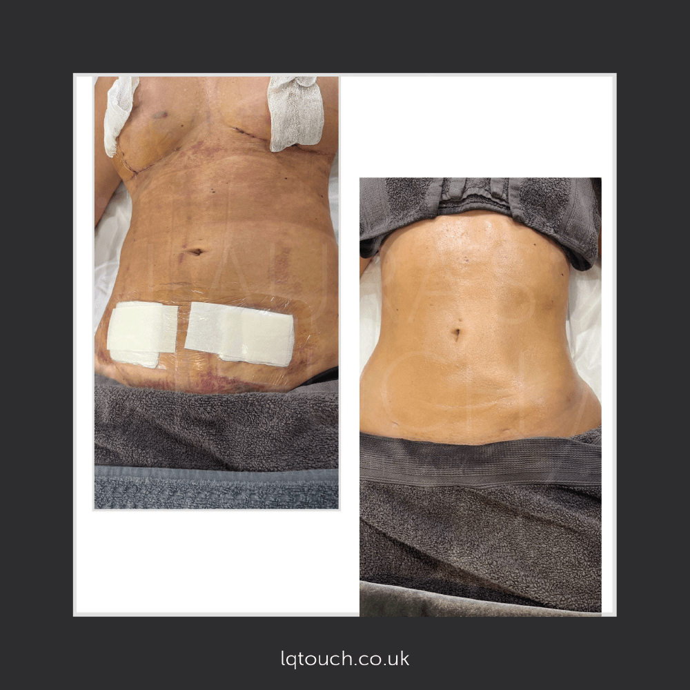 Before and After of a Post Lipo Tummy Tuck and Breast Lift Client