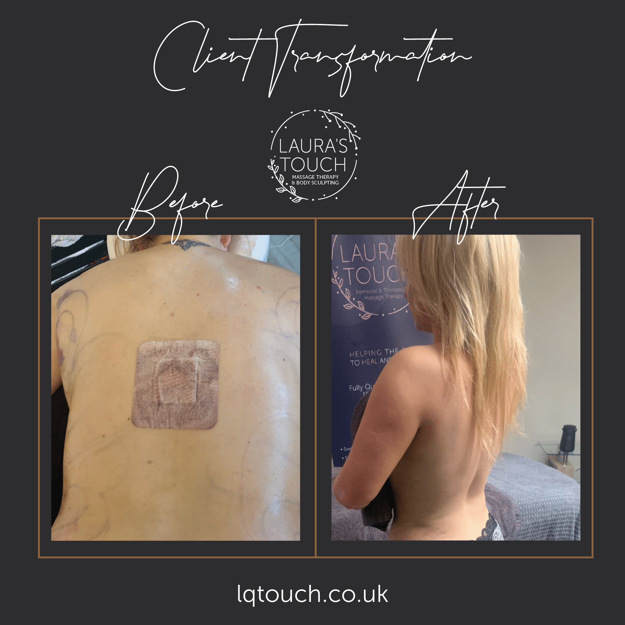 Before and After of a Post Op Manual Lymphatic Drainage Client at Lauras Touch Bromley Clinic