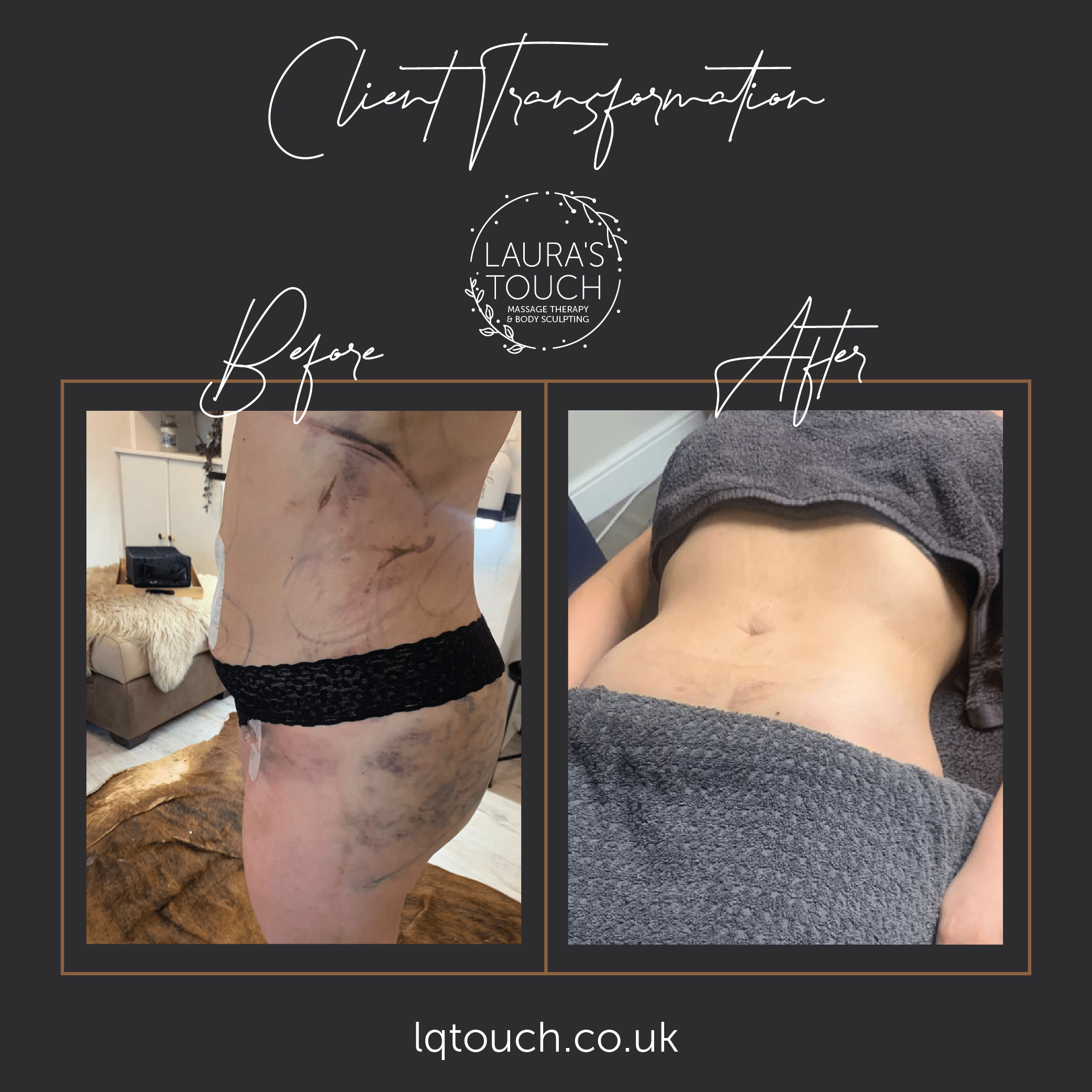 Before and After of a Post Op Manual Lymphatic Drainage Client at Lauras Touch Bromley Clinic