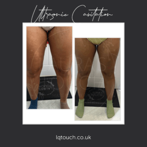 Ultrasonic cavitation at Laura's Touch focused on Inner Thigh