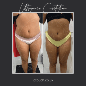 Ultrasonic cavitation at Laura's Touch