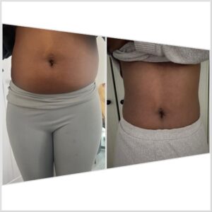 Before and After of x3 sessions of Lemon Bottle Fat Dissolving Treatments