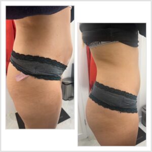 Before and After x3 sessions of Lemon Bottle Fat Dissolving Treatments