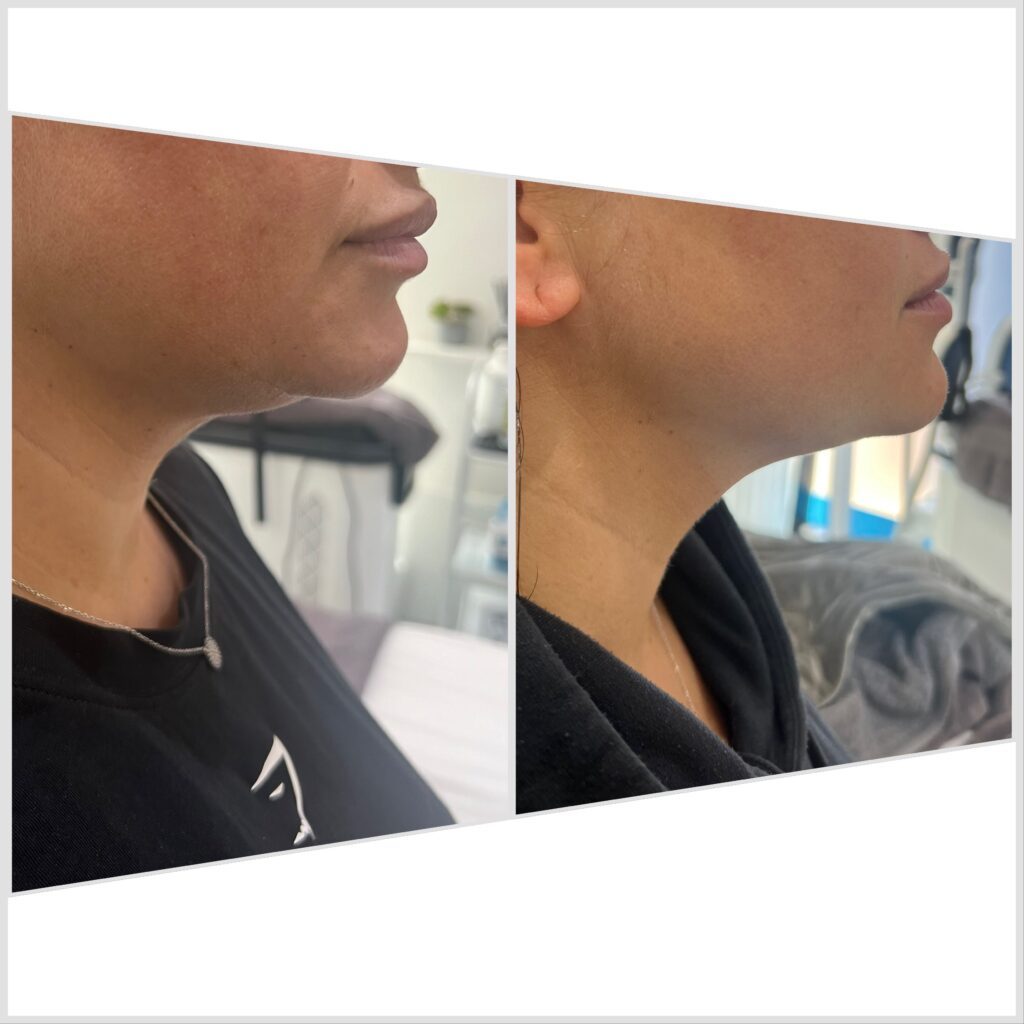 Lemon Bottle Fat Dissolving Treatments Bromley - Laura’s Touch