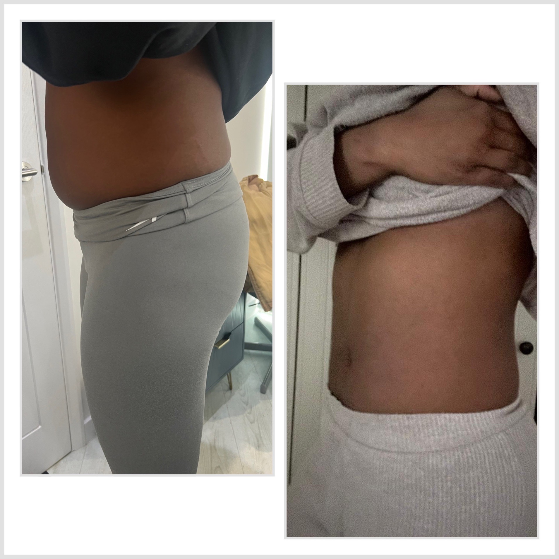 Before and After of x3 sessions of Lemon Bottle Fat Dissolving Injections