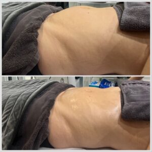 Before and After of a Manual Lymphatic Drainage massage client at Laura's Touch, Bromley Clinic