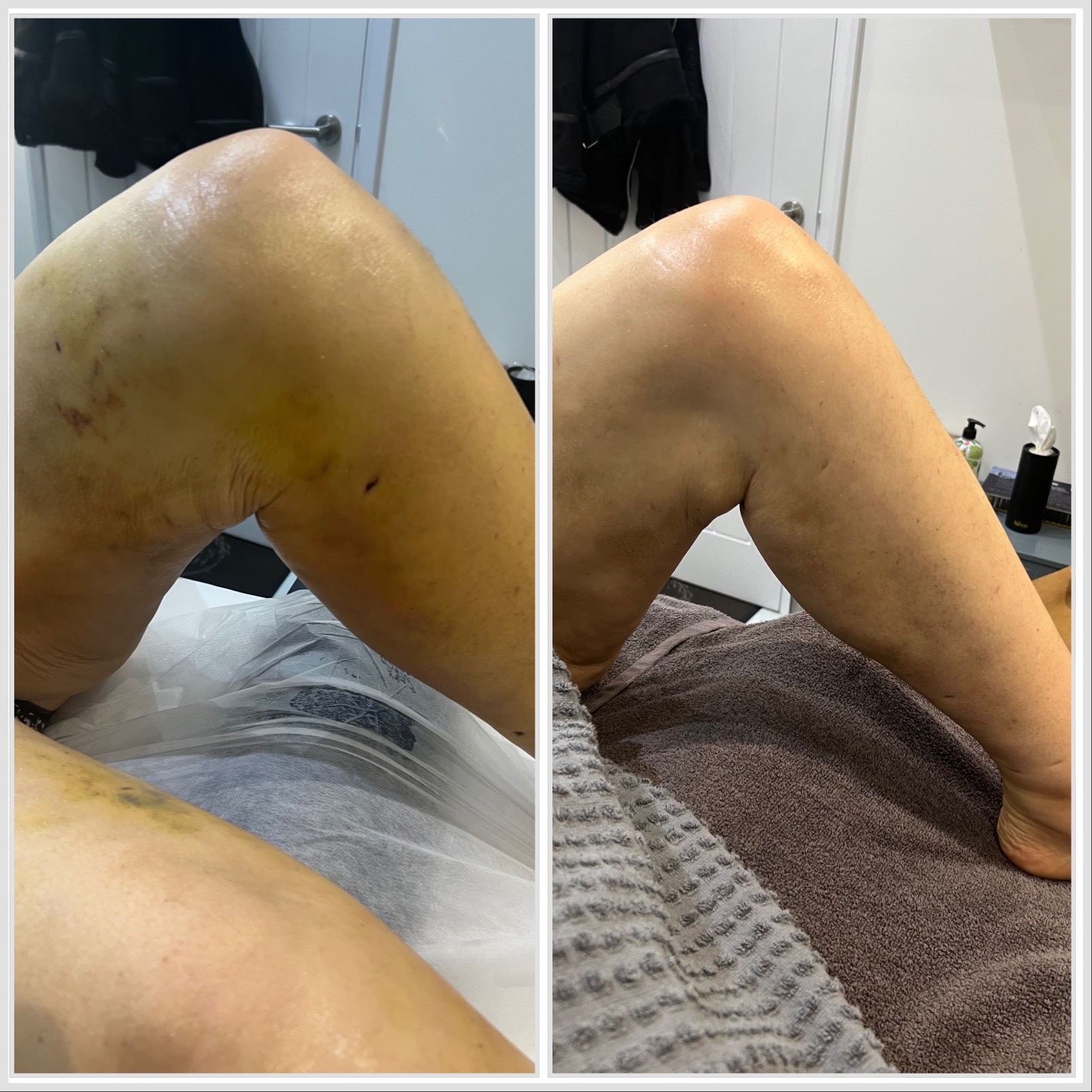 Before and after of a Post-op Manual Lymphatic Drainage client