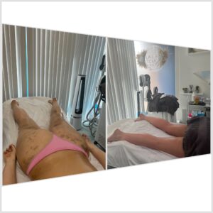 Before and After of a Manual Lymphatic Drainage massage client on the back of the legs at Laura's Touch, Bromley Clinic