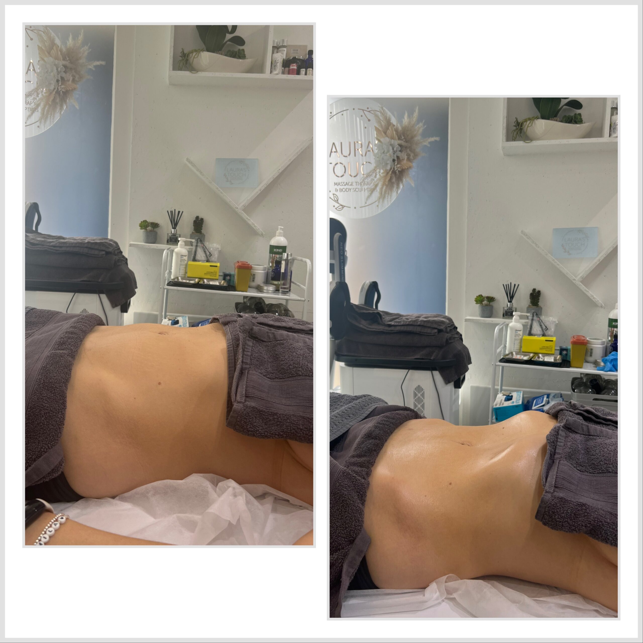 Before and After of a Manual Lymphatic Drainage massage client at Laura's Touch, Bromley Clinic