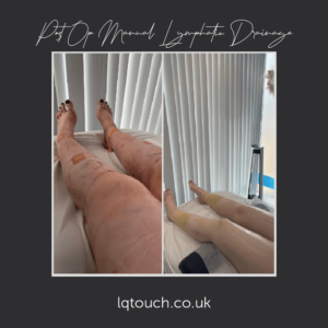 Post Op Manual Lymphatic Drainage