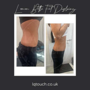 Before & After x3 Lemon Bottle Fat Dissolving Injections