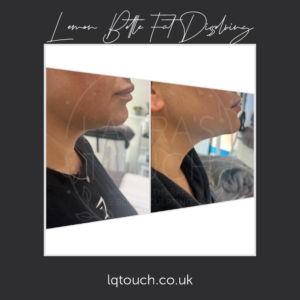 Before and After x2 Lemon Bottle Fat Dissolving Injections