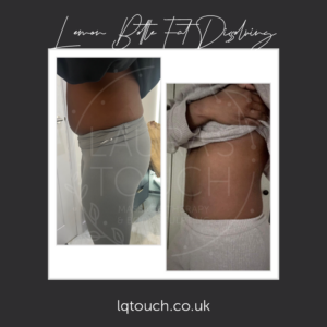 Before & After x3 Lemon Bottle Fat Dissolving Injections