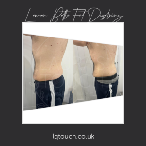 Before & After Lemon Bottle Fat Dissolving Injections