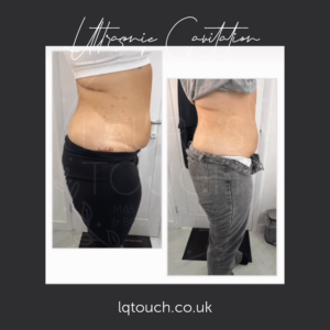 This client purchased X6 package of 90 mins Ultrasonic Cavitation combined with Radio frequency to start her weight loss journey.