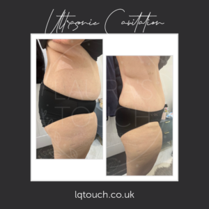 Ultrasonic Cavitation for this client at Laura's Touch