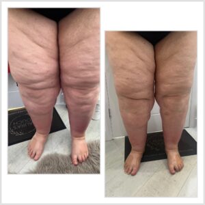 Before and after regular Manual Lymphatic Drainage treatments to manage the condition lipoedema