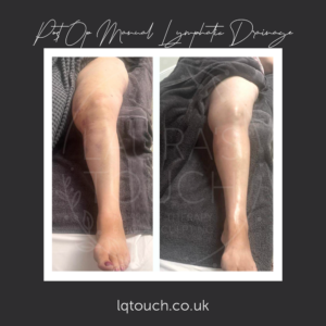 Post Op MLD For Liposuction Client