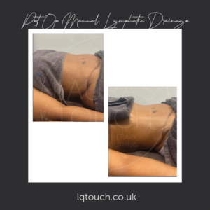 Post Op Manual Lymphatic Drainage