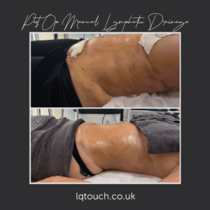 Post Op Manual Lymphatic Drainage Client