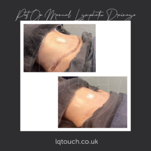 Before and After of a Post Op Manual Lymphatic Drainage Client