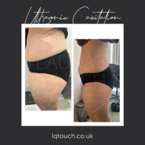 Ultrasonic Cavitation For a Client at Laura's Touch