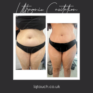 Ultrasonic Cavitation For a Client at Laura's Touch