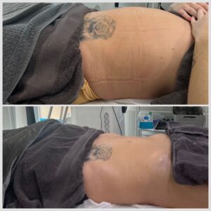 Before and After Manual Lymphatic Drainage Massages for the post caesarean section block booking client 