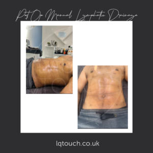 Post Op Manual Lymphatic Drainage